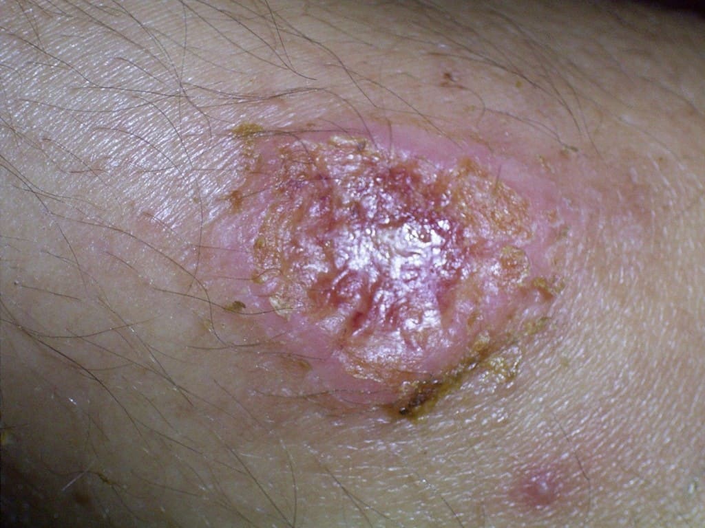 body parasites on skin